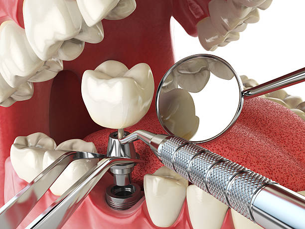 Best Emergency Root Canal Treatment in Whitehouse, TX